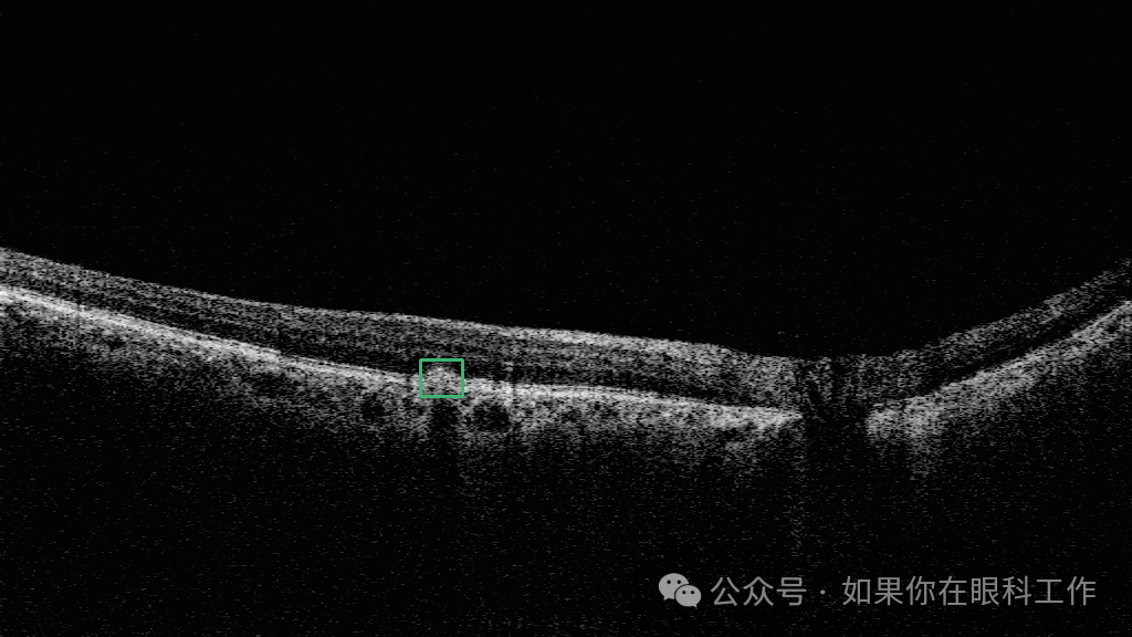 2025年1月21日弄明白玻璃体相关的疾病，玻璃膜疣是玻璃体相关疾病吗？插图(6)